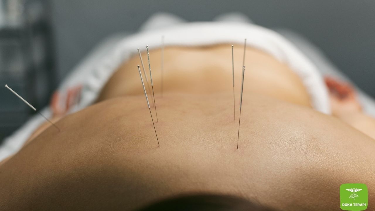 Akupunktur tedavisi yapılan bir kadın ve akupunktur iğneleri vardır.