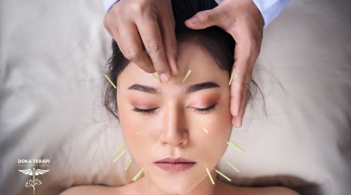 Yüz akupunkturu olan kadın bir hasta